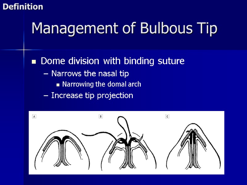 Dome division with binding suture Narrows the nasal tip Narrowing the domal arch 